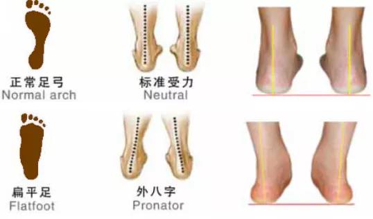 家长如何帮助矫正扁平足,孩子扁平足用不用治