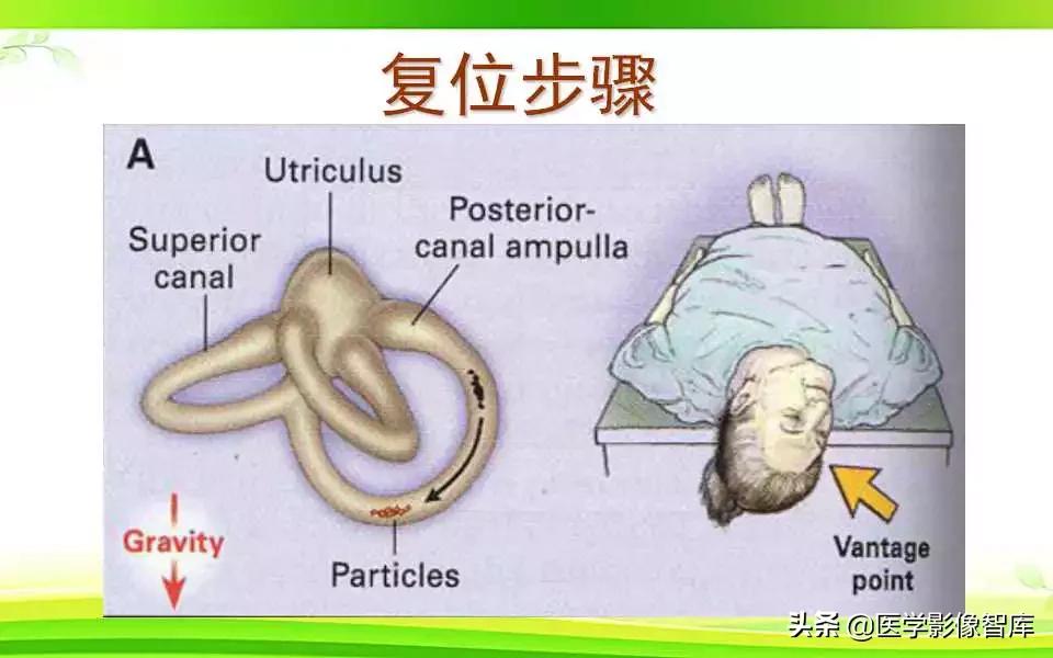 容易被误诊为耳石症的疾病,耳石症眩晕怎么确诊