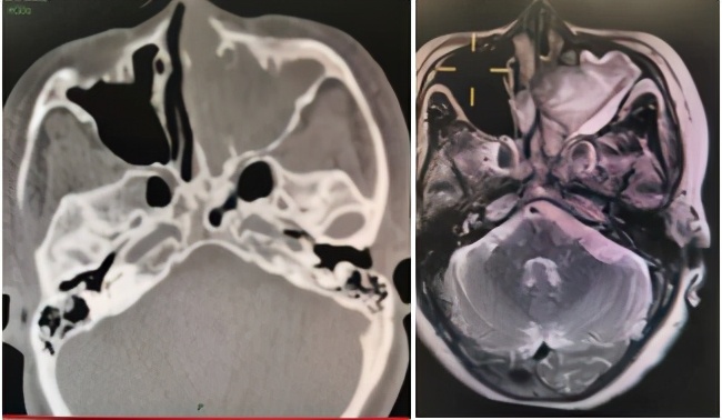 鼻出血保健手法,鼻出血的自我检测