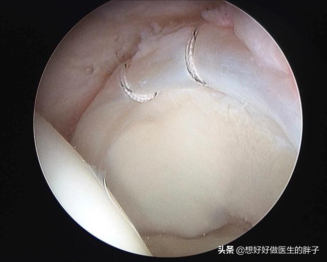 髋关节疼痛两腿不一样长如何康复,左大腿髋关节突然疼痛是什么原因