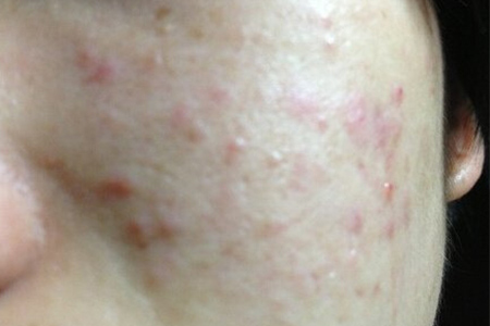 红肿脓包型痘痘反复化脓用什么药,脓包型痘痘的修复六招教你怎么做