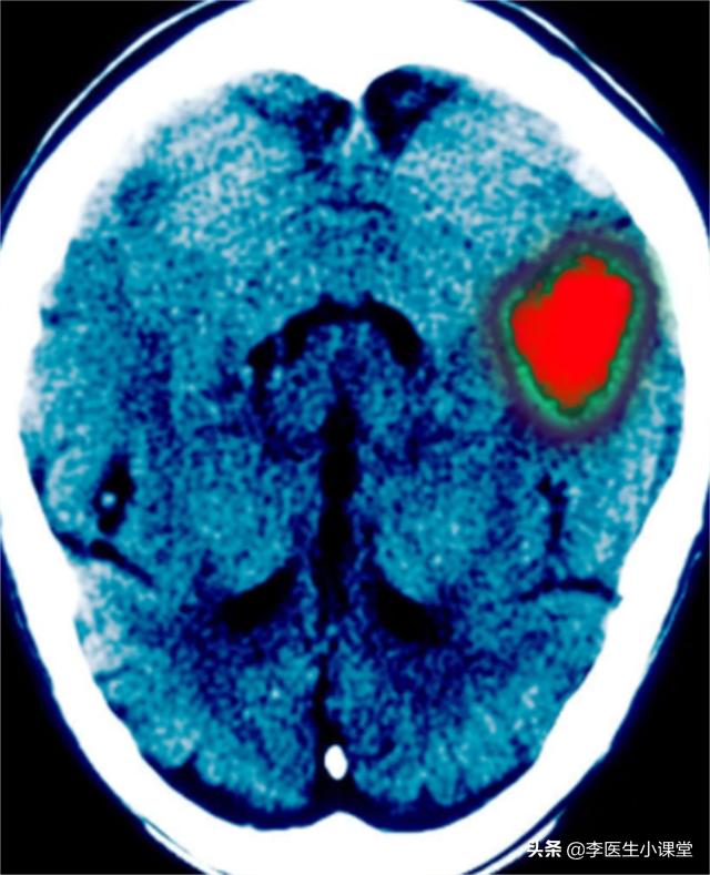 血压高突发脑出血怎么治疗30岁,高血压脑出血突然发作该如何急救