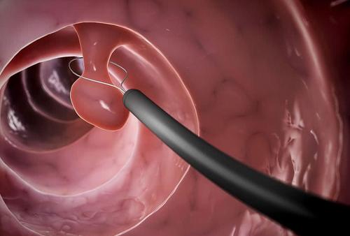 所有的腺瘤息肉都会癌变吗,所有的息肉都必须切除吗