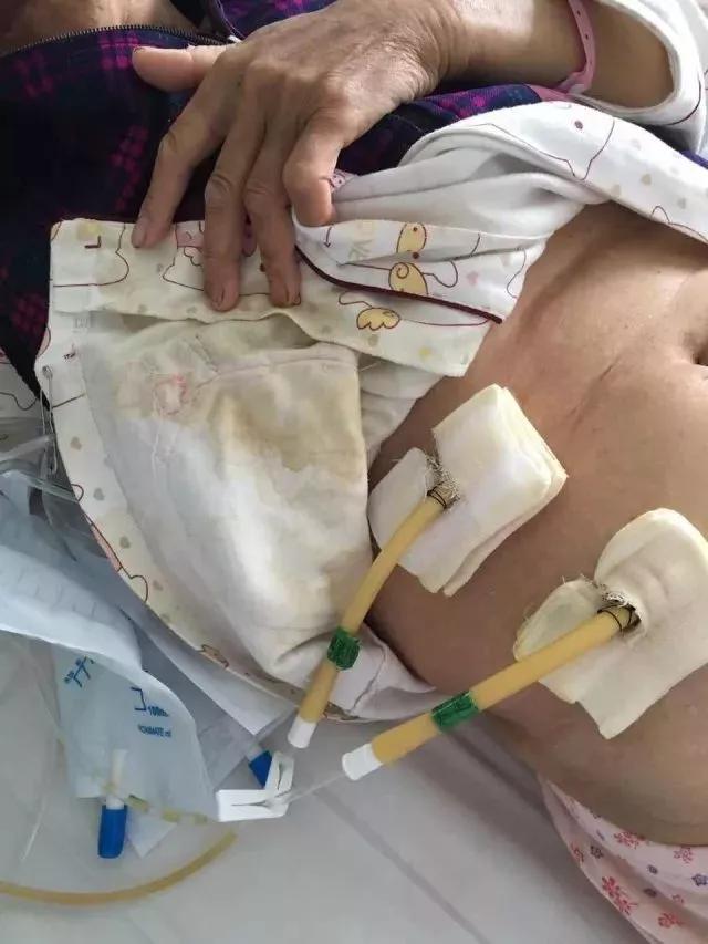 引流伤口有渗液流出怎样处理,术后20天引流液还很多怎么办