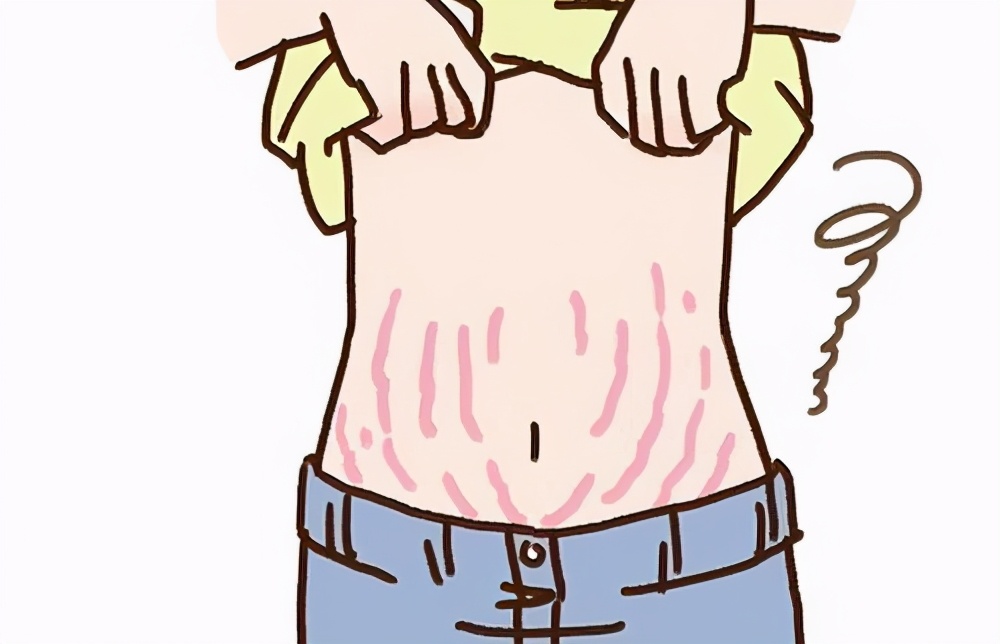 不胖却有生长纹,不胖也会有生长纹