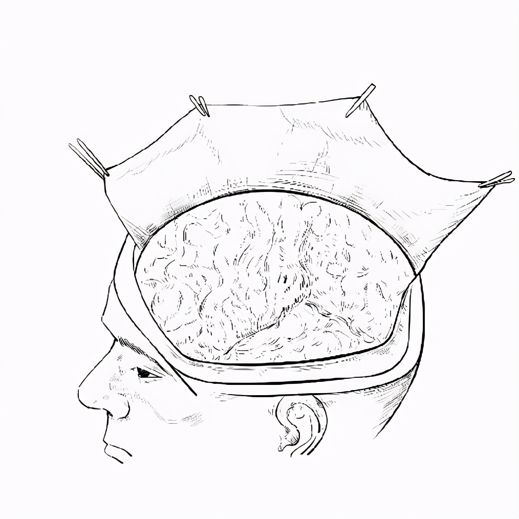 极限挑战：缝合人体最神秘的器官