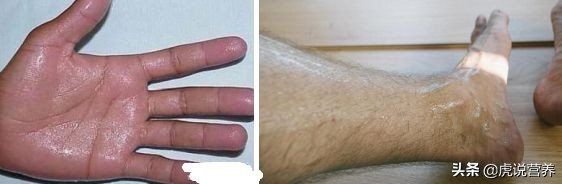手足多汗有哪些方法,人多汗多怎么回事