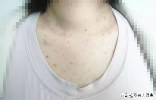 硫软膏治疗马拉色菌毛囊炎,马拉色菌毛囊炎可以输液吗