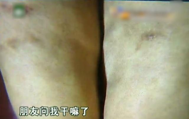 女子花8万做抽脂减肥,女子花68万做十次抽脂术