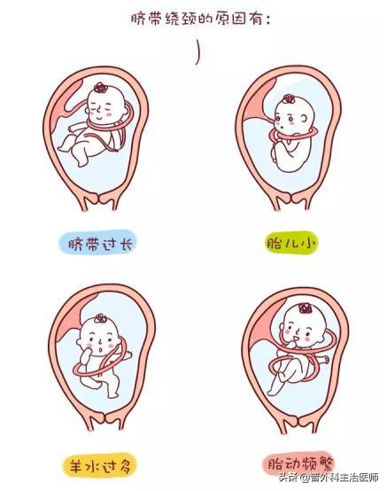 胎死宫内的刽子手-------脐带缠绕