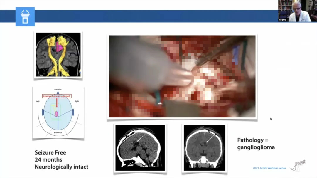 儿童癫痫治愈的真实案例,儿童难治性癫痫有哪些