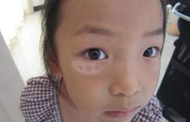 白斑随“期”而变，不同时期白癜风的特点你知道多少？