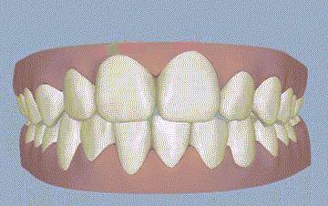 下巴后缩怎么拍侧颜,下巴后缩需要怎么矫正