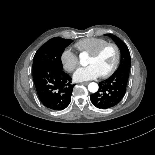 如何监测动脉夹层早期,动脉增强ct能查出主动脉夹层么