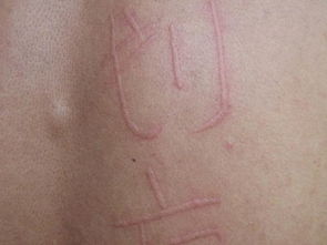 人工性荨麻疹是什么原因导致的,人工性荨麻疹是怎么造成的