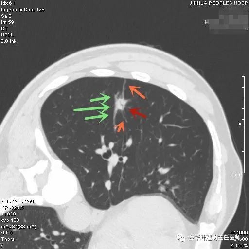 叶建明谈胸膜下的实性结节,叶建明肺实性良性结节会变癌症吗