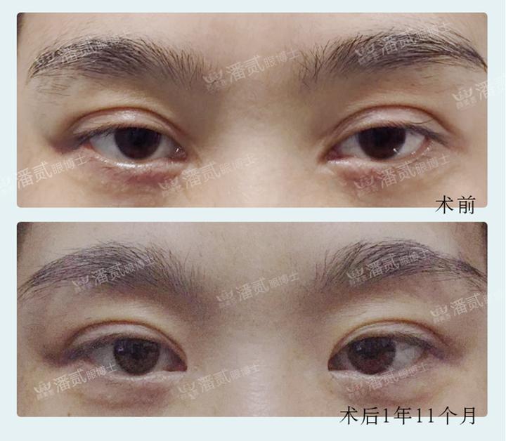 双眼皮整形的真实经历,为什么做双眼皮医生术前不沟通