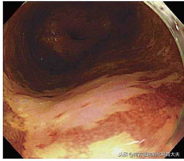 碘染色粉红色是癌吗,食道碘染色不染色代表是癌吗