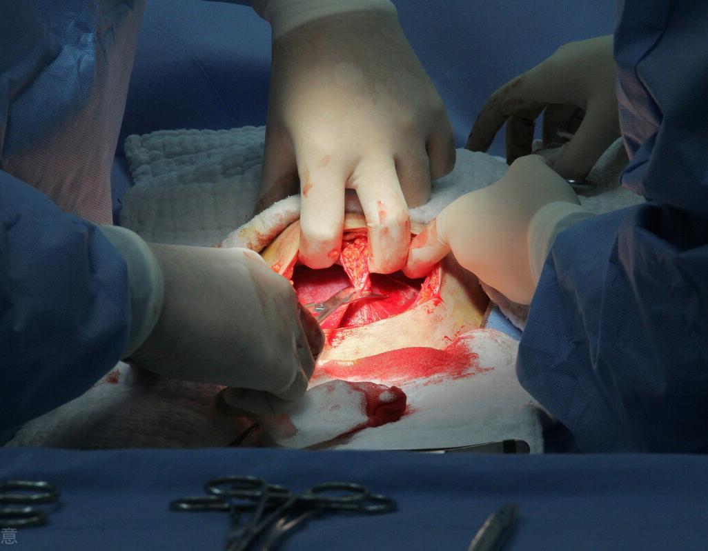 剖腹产后遗症都有什么,剖腹产顺带结扎有后遗症吗