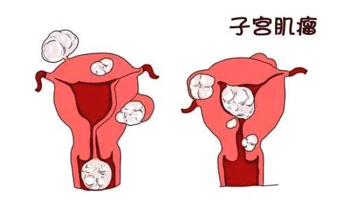 子宫肌瘤有什么症状可以自愈吗,子宫肌瘤该不该切子宫