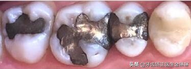 补牙材料银汞吃下去了要紧吗,补牙的银汞材料边缘掉了一点