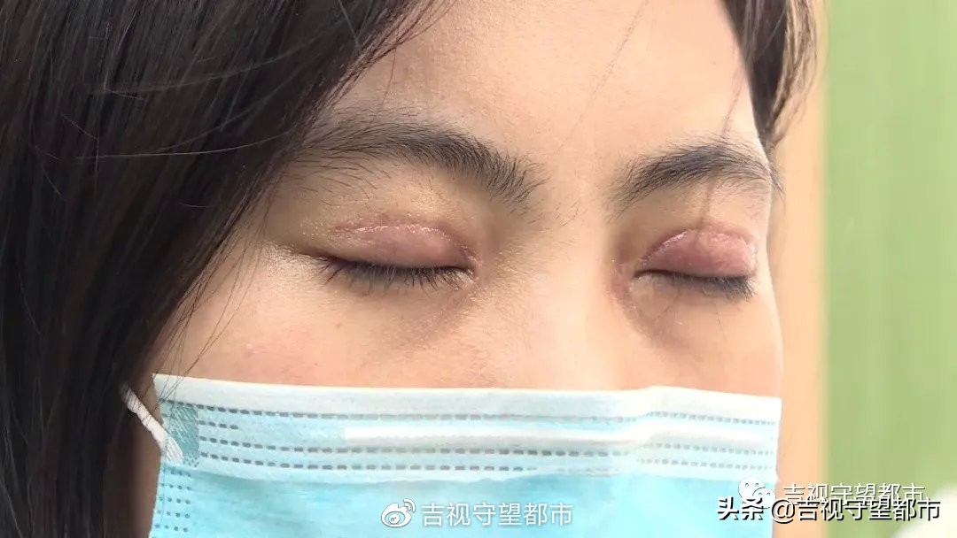 公寓做双眼皮效果好吗,私人公寓做的双眼皮失败了