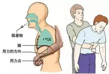 幼儿误吞磁力珠致小肠穿孔,女孩误吞磁力珠致6处肠穿孔