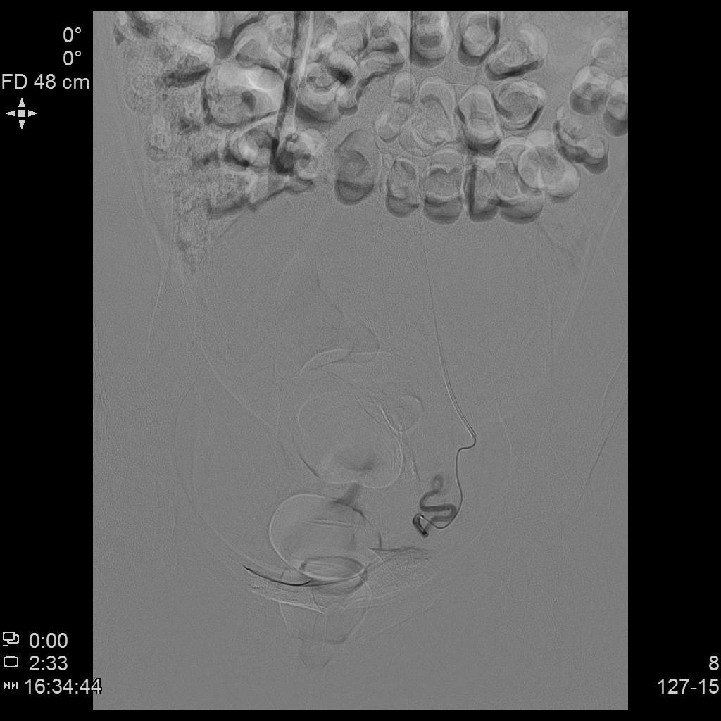 从手腕处做子宫动脉栓塞手术,子宫肌瘤做动脉穿刺有危险吗