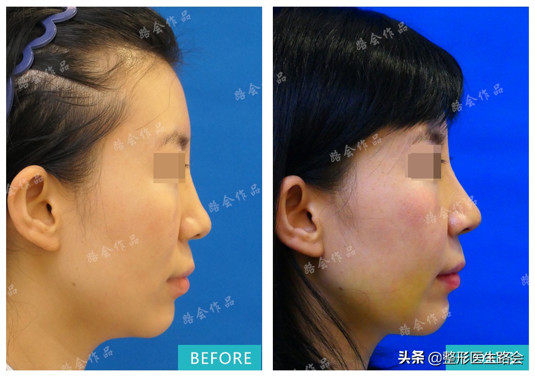 膨体隆鼻3年了鼻尖要露出来,膨体隆鼻会有严重的后果