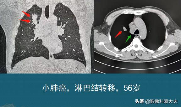 肺癌晚期胃癌,肺癌和胃癌晚期的状况