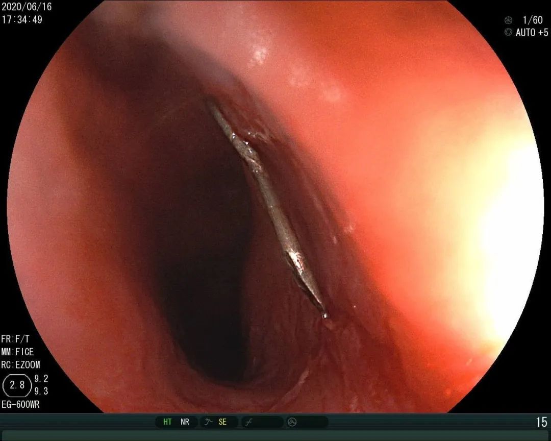 食堂吃到针头,饭菜吃进喉咙的时候感觉有点抵触