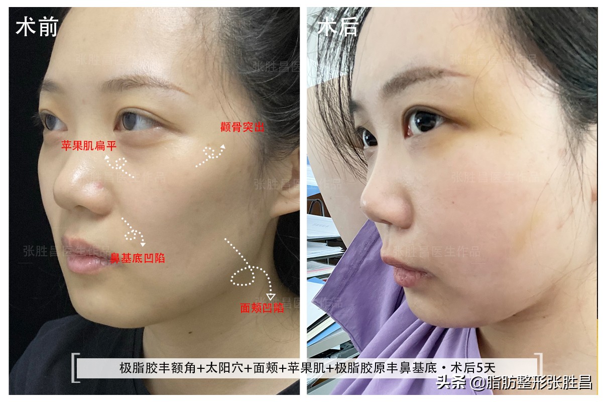 30岁龅牙矫正牙齿后脸型变化图,牙齿矫正使脸型凹陷会恢复吗