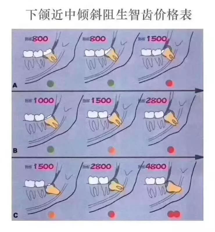 埋得越深,分手费越高——你所不知道的拔智齿收费依据