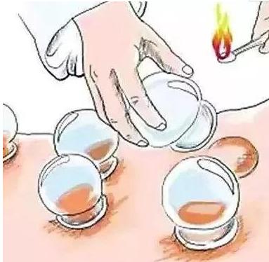 拔罐有水泡和血泡是代表什么,如何快速缓解拔罐出现的印子