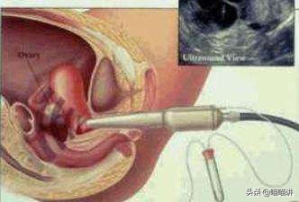阴式b超检查有什么弊端,做阴式b超检查有什么危害