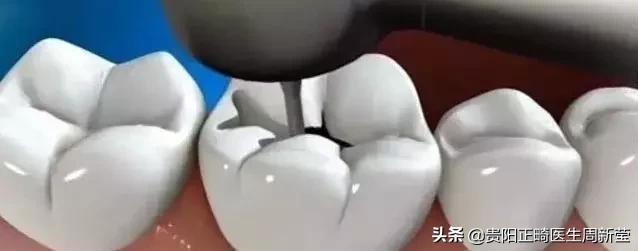 牙釉质不同程度缺损及相应的处理方法,你必须要注意