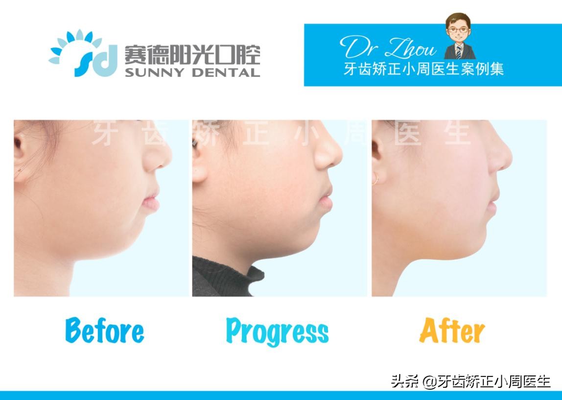 下巴后缩整容玻尿酸还是假体,如何不靠整容改变下巴