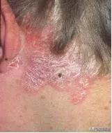 全身痒掉皮屑有什么征兆,浑身瘙痒发红是过敏了吗