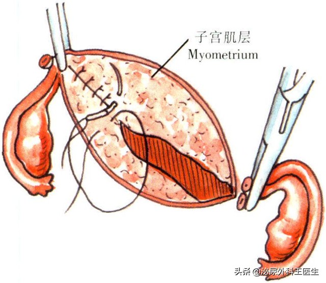 女人切除子宫后身体会有4种变化,女人切除子宫对生活有影响吗