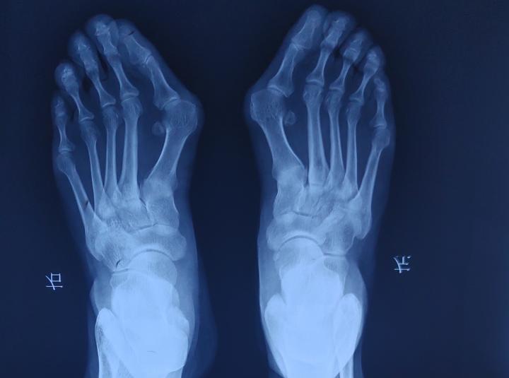 脚大拇外翻和痛风有什么区别,大脚趾痛风和拇外翻的区别