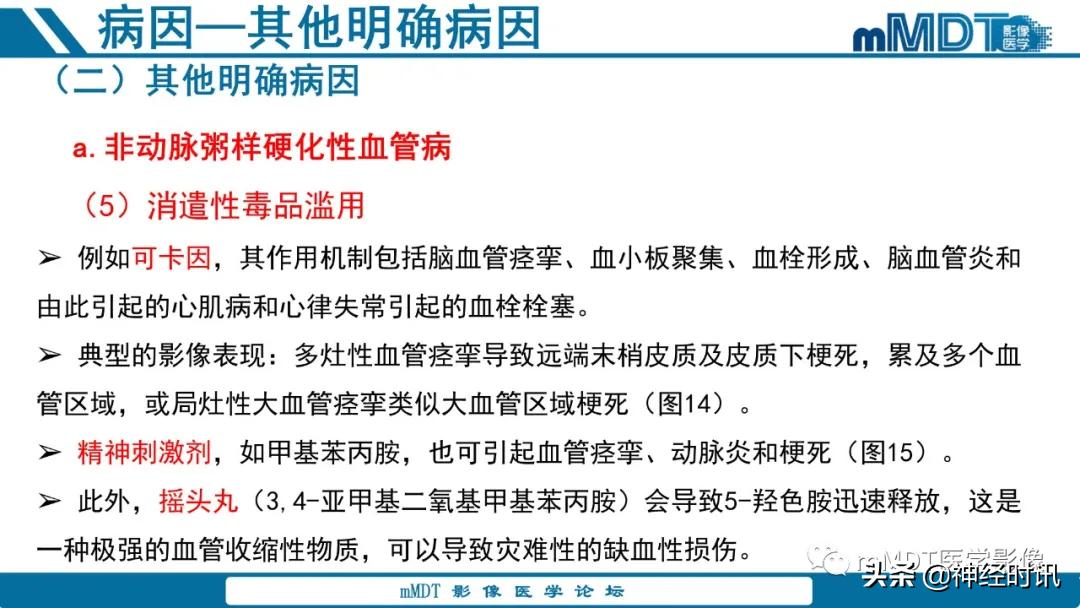 急性缺血性脑卒中ppt素材图片,青年缺血性脑卒中ppt