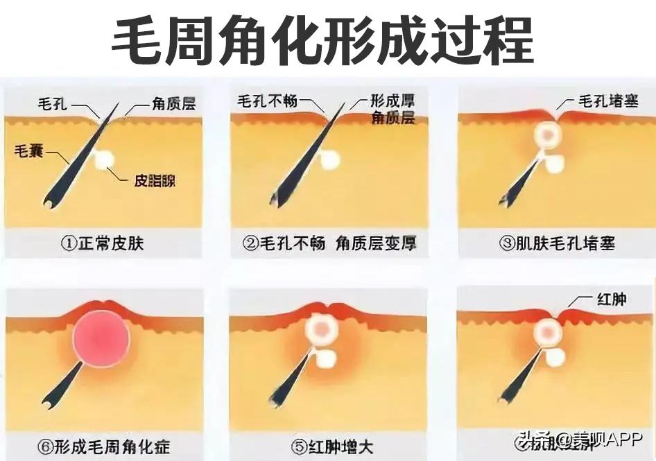 春季鸡皮肤大作战!去毛周角化也要分种类好吗?