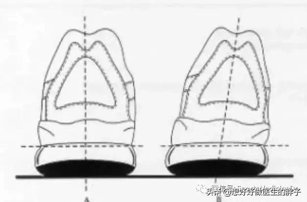 一个方法解决足跟痛,什么方法缓解足跟痛