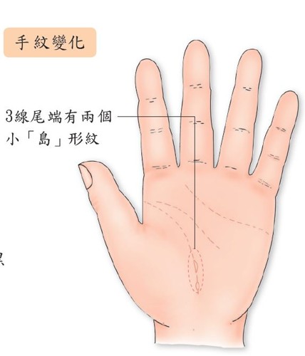 子宫肌瘤手相,子宫肌瘤的反射区手上
