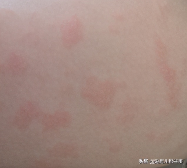 很恐怖的过敏图片,过敏发朋友圈的真实图片