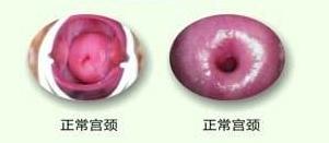 更年期出血是不是宫颈癌,妇科检查出血是宫颈癌吗