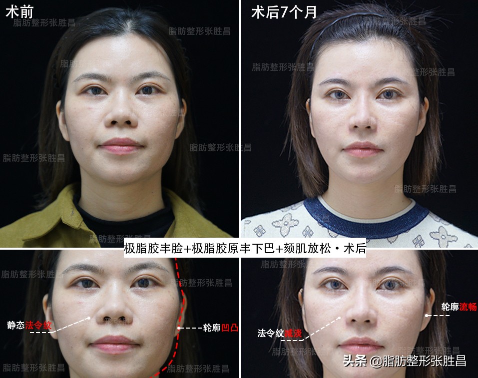 颧骨太高整形,颧骨高怎么整形有什么后遗症