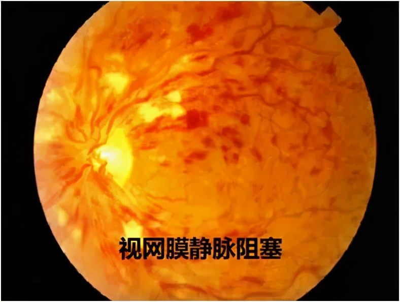 眼底刚查正常但突然有飞蚊症,眼病早知道的症状