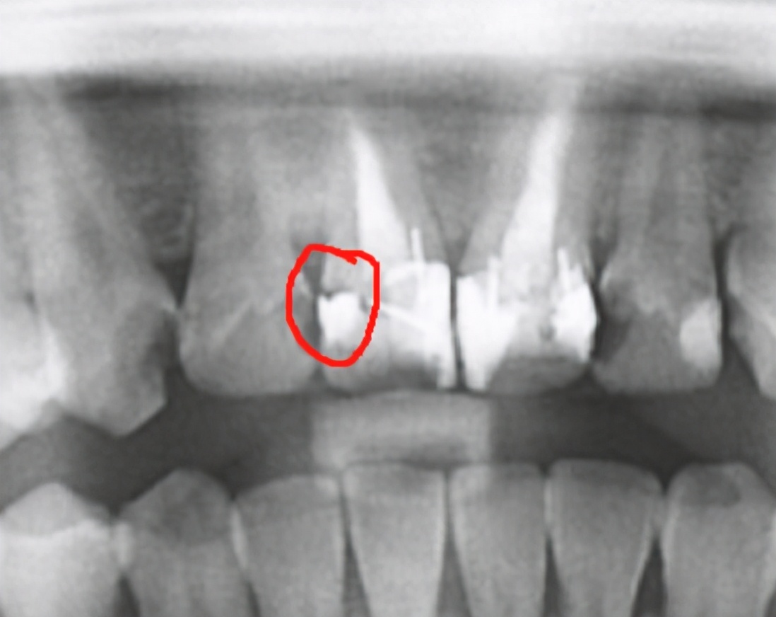 补牙后敏感遇冷热疼痛,补牙后牙齿敏感怎么处理最好