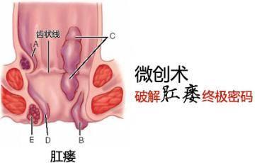 高位复杂性肛瘘最好的治疗方法,高位复杂性肛瘘不痛不痒不流脓